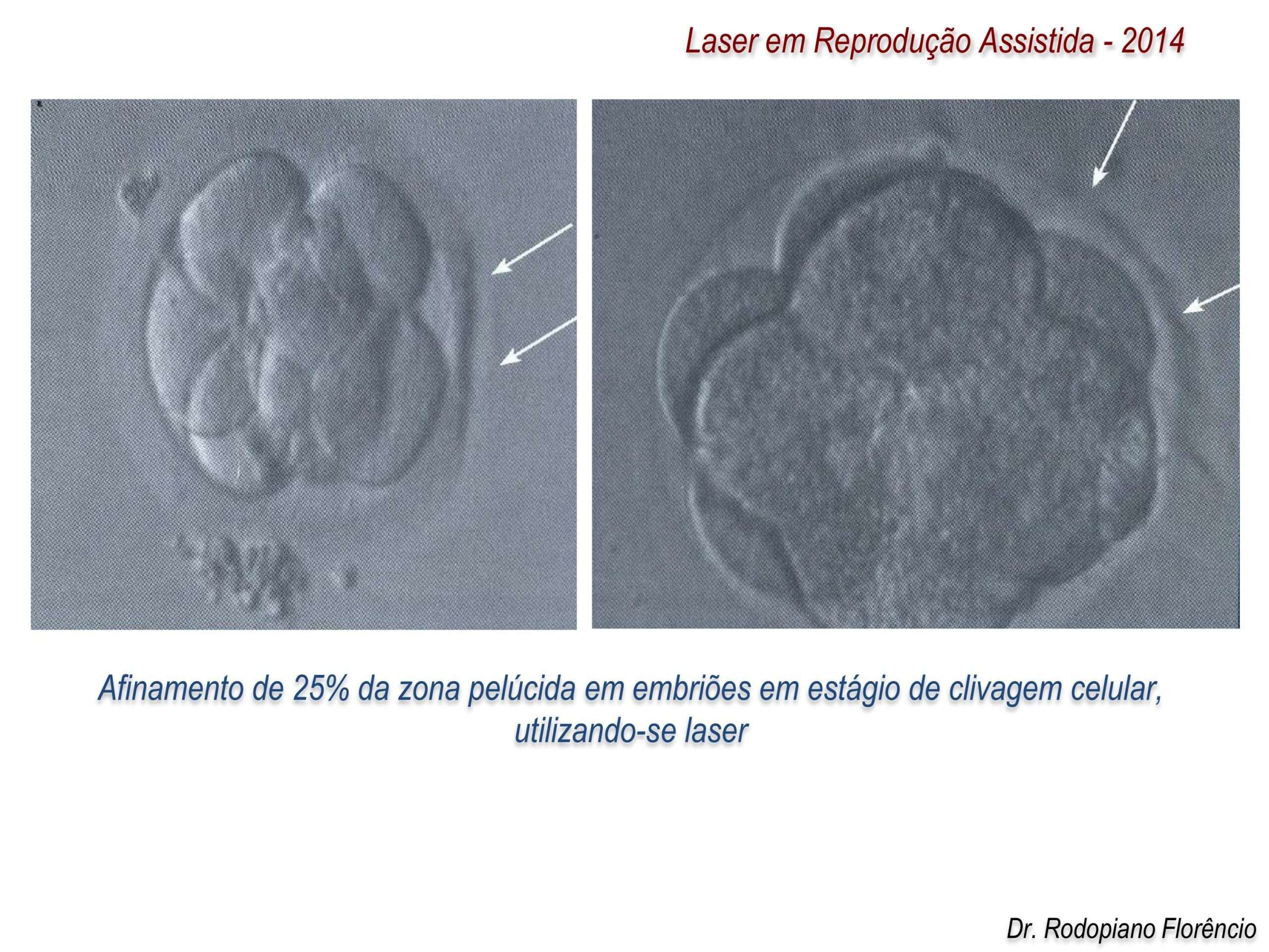Laser-em-Reprodução-Assistida-2014-13
