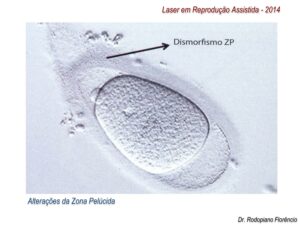 Laser-em-Reprodução-Assistida-2014-4
