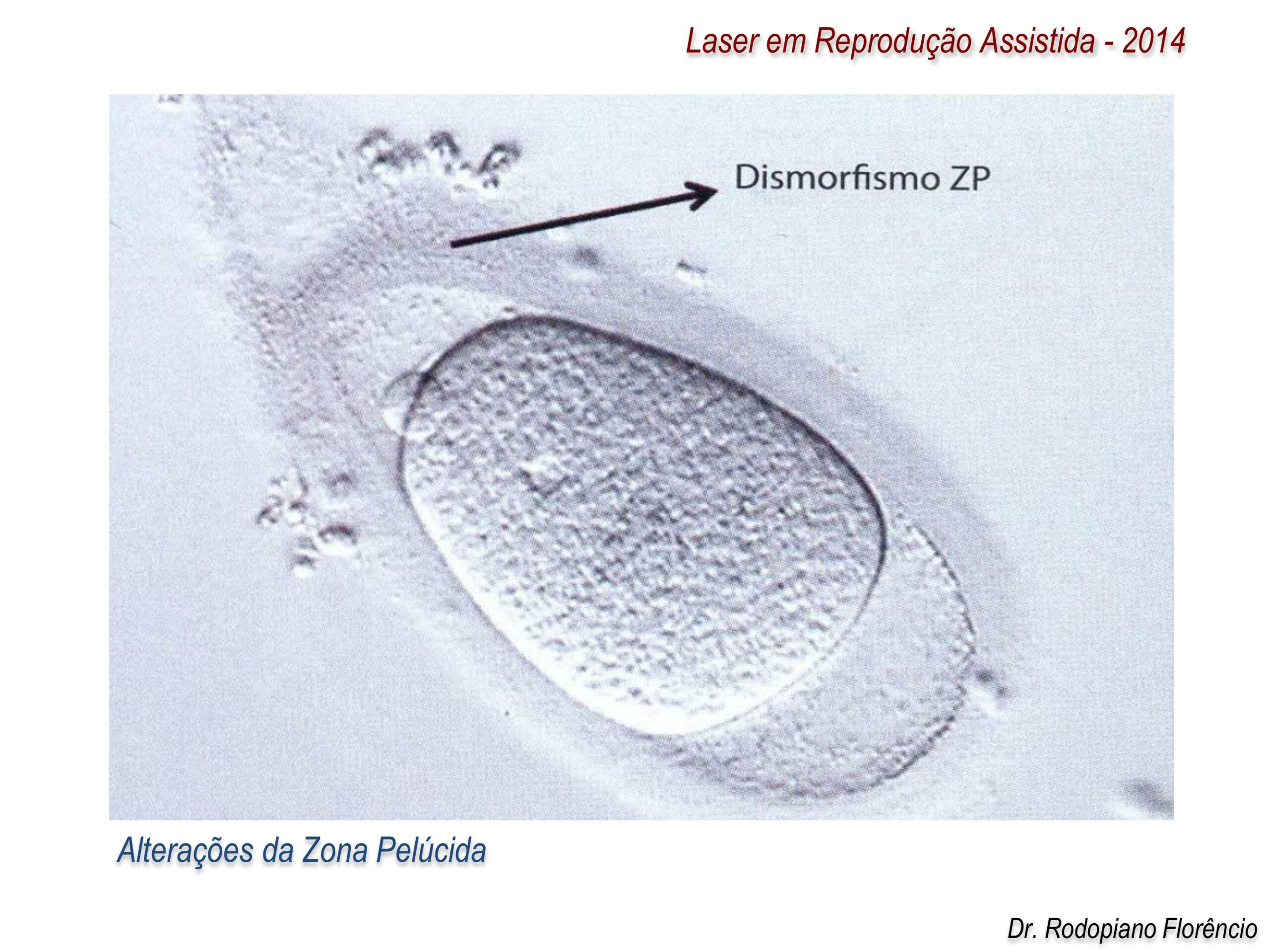 Laser-em-Reprodução-Assistida-2014-4