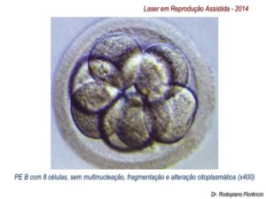 Laser-em-Reprodução-Assistida-2014-5