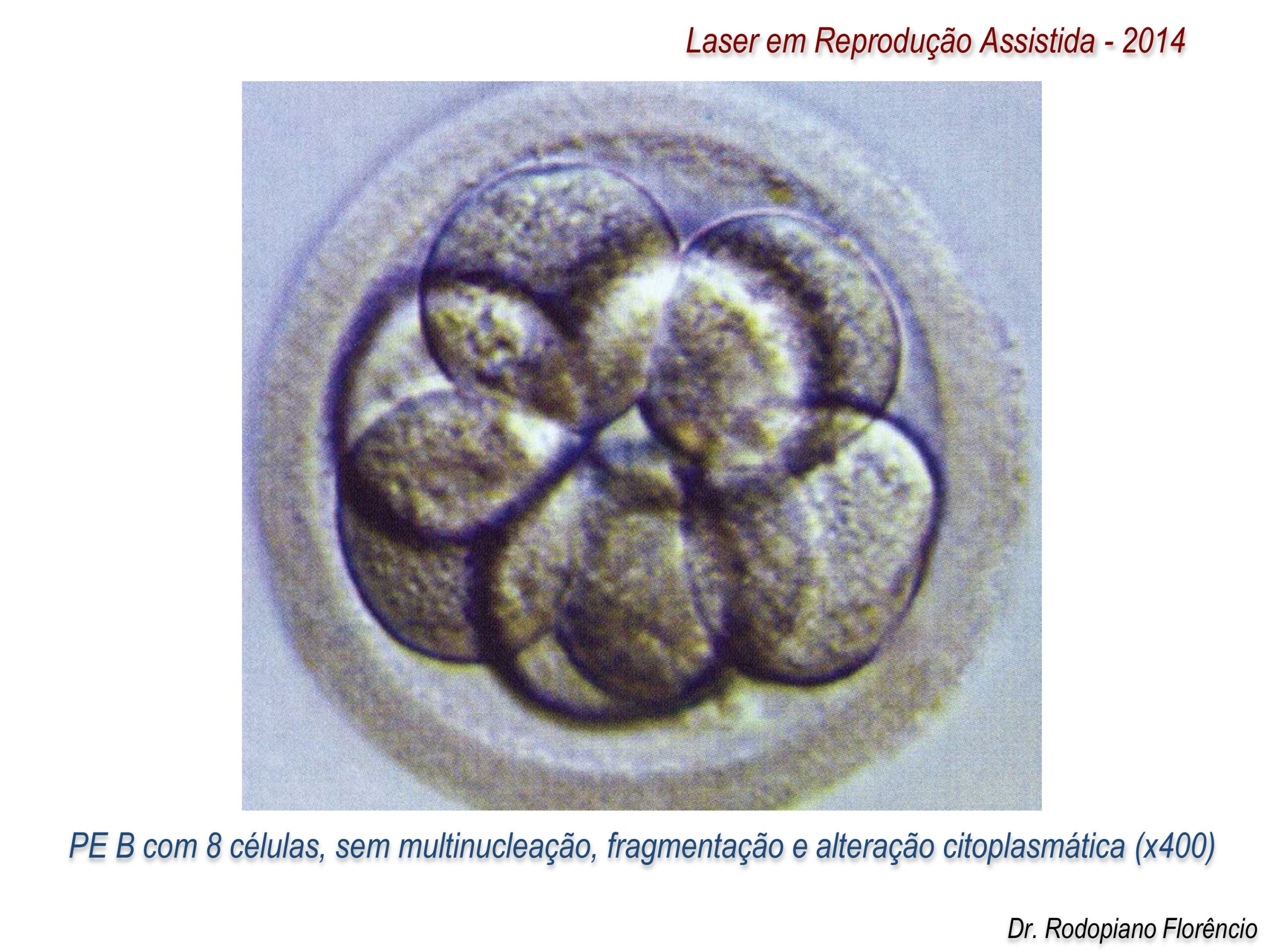 Laser-em-Reprodução-Assistida-2014-5