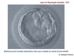 Laser-em-Reprodução-Assistida-2014-6