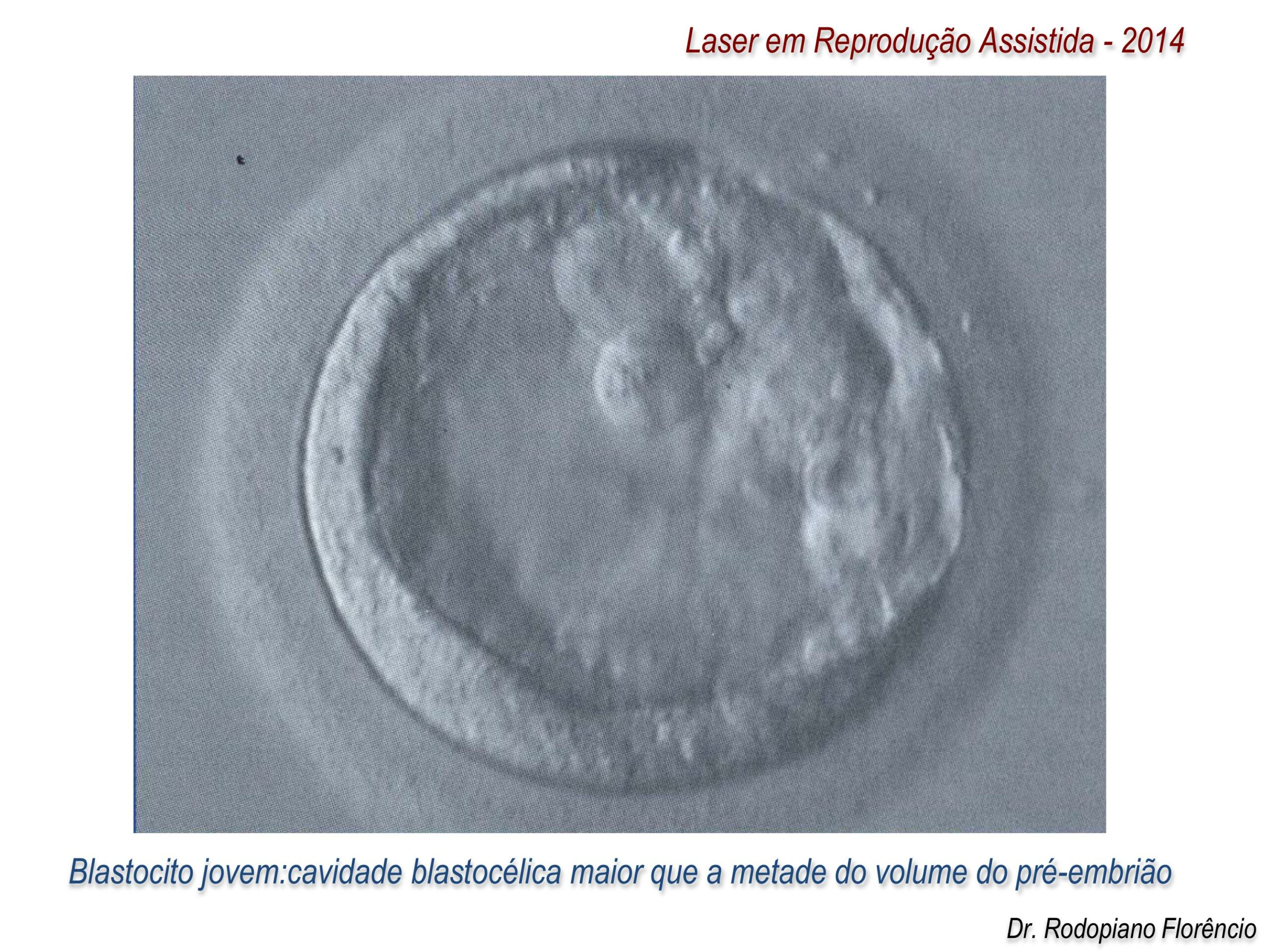Laser-em-Reprodução-Assistida-2014-6