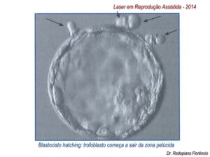 Laser-em-Reprodução-Assistida-2014-7