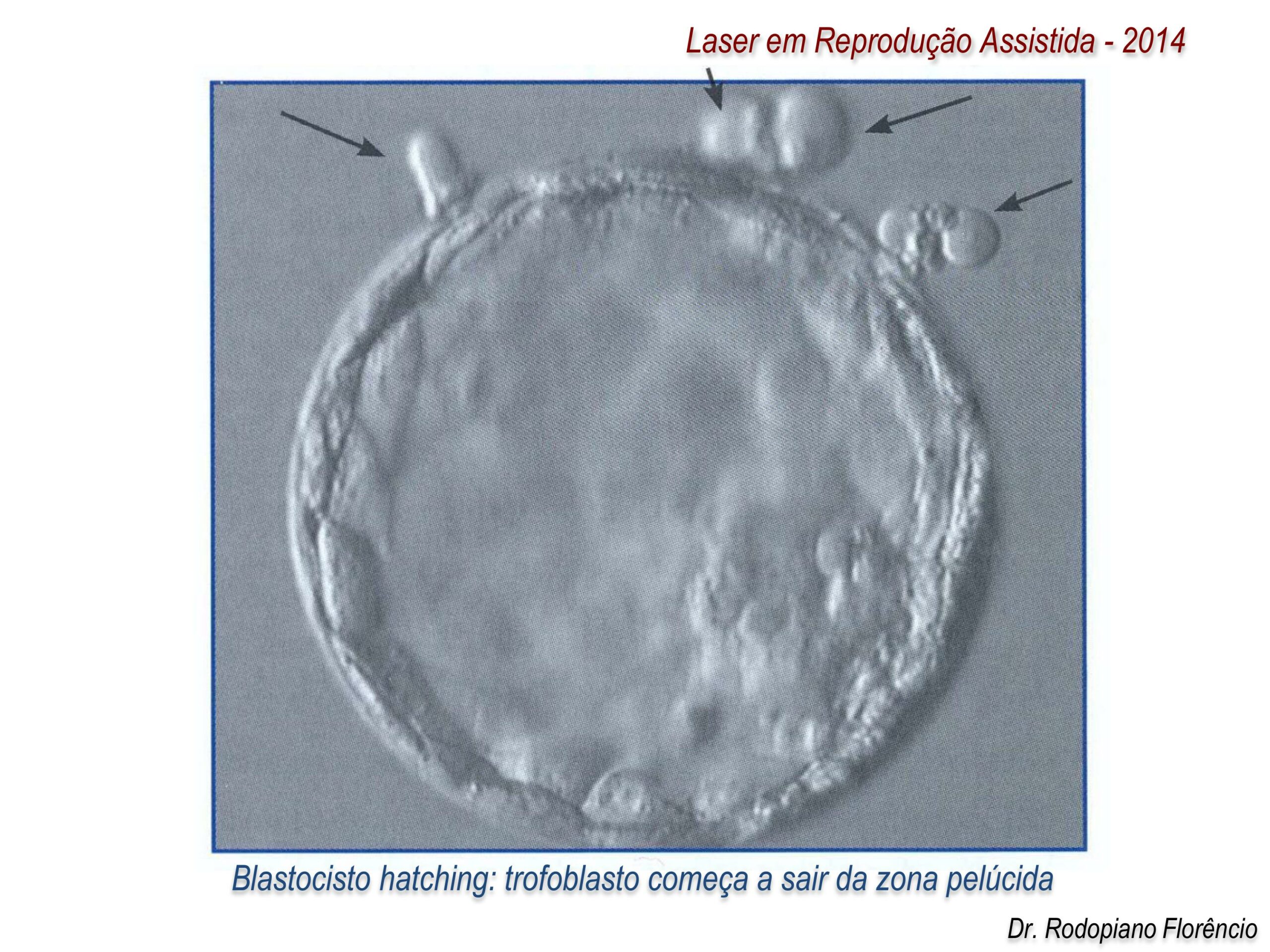 Laser-em-Reprodução-Assistida-2014-7